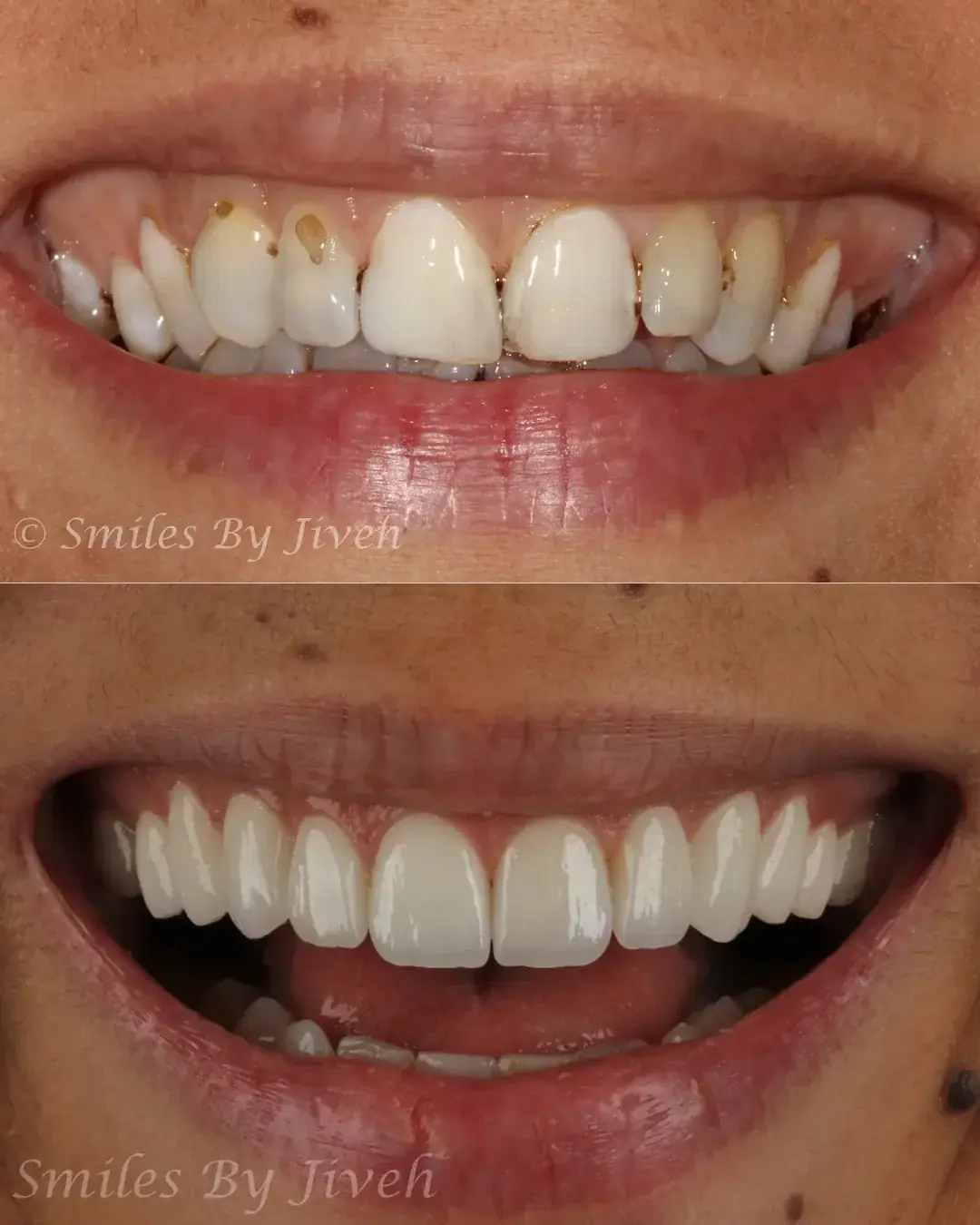 Before and after porcelain veneers by Smiles By Jiveh