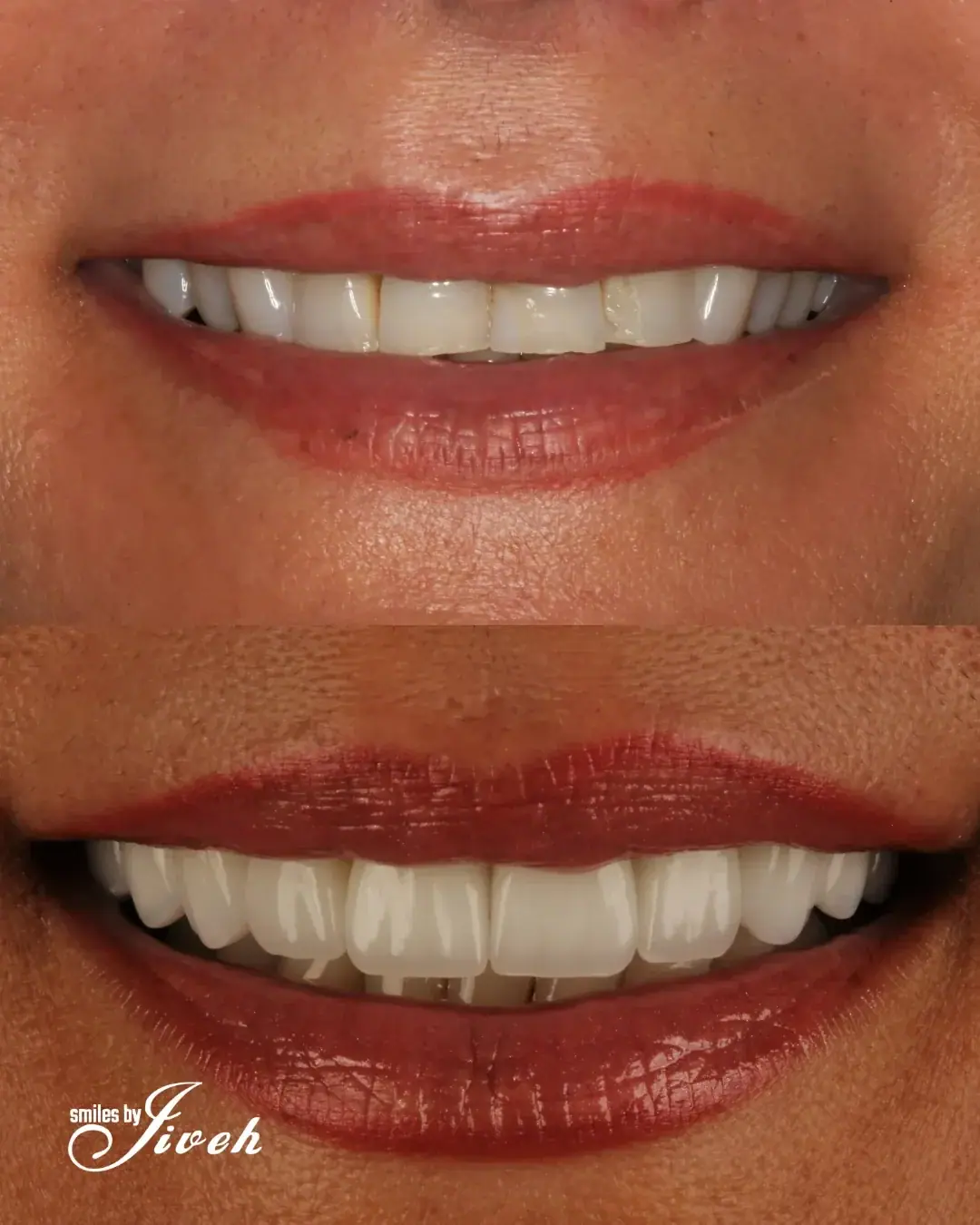 Before and after smile enhancement by Smiles By Jiveh