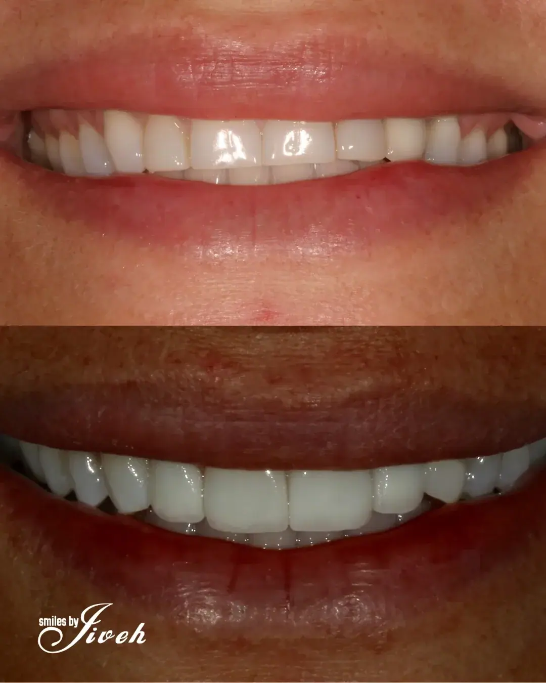 Before and after smile transformation by Smiles By Jiveh